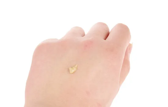 比度克拔毒膏好用吗 中药成分可以促进痘痘的熟化